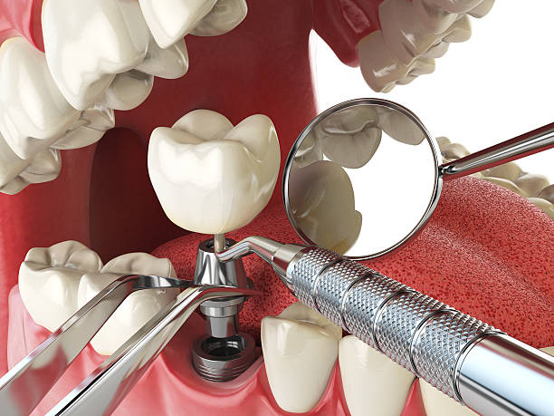 Best Emergency Dental Care for Broken or Chipped Teeth in Middlefield, OH